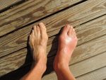 Barefoot Human Feet Pain Foot Anomaly Gout